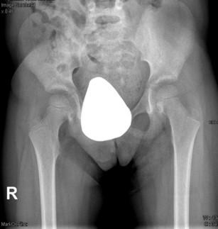 234 Figura 5: Reavaliação em consulta externa cerca de 2 anos pós luxação. A luxação traumática da anca nas crianças é rara e extremamente rara se menores de 5 anos de idade.