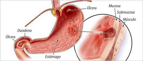 Úlcera Péptica Conceito: Lesão ulcerada que pode ocorrer nas mucosas do esôfago, estômago e duodeno, devido à secreção ácida de estômago.