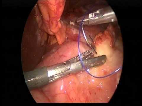 Úlcera Péptica Complicações: Hemorragia, devido perfuração; Obstrução pilórica, devido processo de cicatrização.