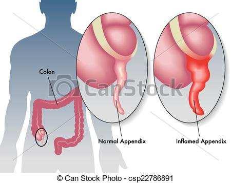 Apendicite Conceito: Inflamação aguda do apêndice.