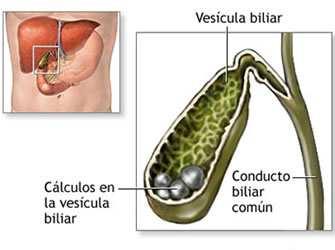 Colecistite Conceito: Inflamação da vesícula e vias biliares. Pode ser aguda ou crônica, frequentemente associada à coletitíase (presença de cálculos na vesícula e vias biliares).