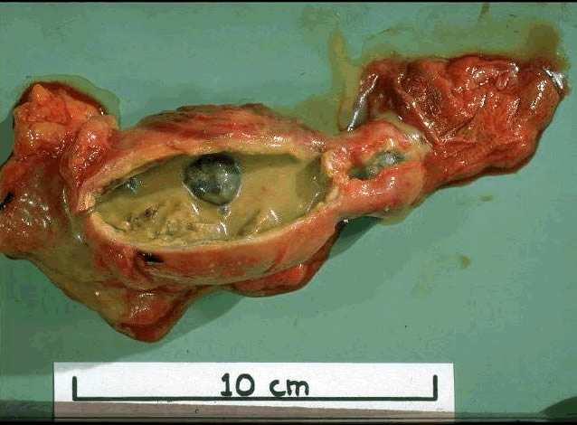 Colecistite Tratamento: Cirúrgico: Colecistectomia/ Coledocotomia.