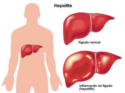 Hepatite Conceito: Doença inflamatória do fígado normalmente causada por vírus.
