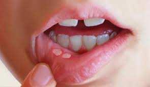 Estomatite Conceito: Inflamação da mucosa oral podendo ocorrer ulcerações,