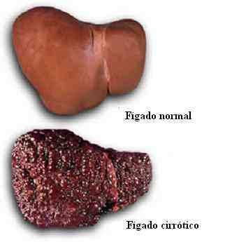 Hepatite Cirrose Hepática Conceito: Lesão do