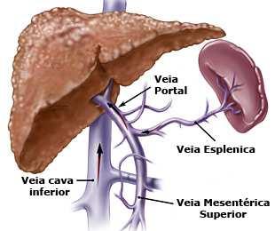 Cuidados de enfermagem: Cirrose Hepática Apoio emocional; Estimular alimentação, orientando quanto à importância da dieta; Proporcionar repouso e ambiente calmo; Verificar peso diariamente; Medir