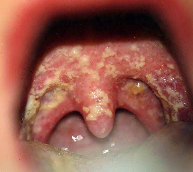 Estomatite Tratamento: Higiene da cavidade oral com substâncias alcalinas (elevar o ph), como