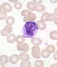 Mieloproliferativas LMC