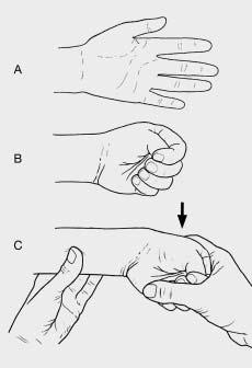 Figura 3 - Manobra de Finkelstein (2). do carpo pode produzir uma atrofia tenar, notada em região palmar na base do polegar.
