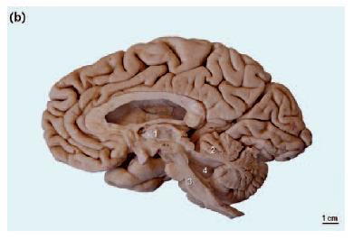 A B Figura 1: Alterações macroscópicas na AEC3. Em A vê-se um corte sagital do hemisfério cerebral direito de um indivíduo sem história médica de doenças neurológicas ou psiquiátricas.