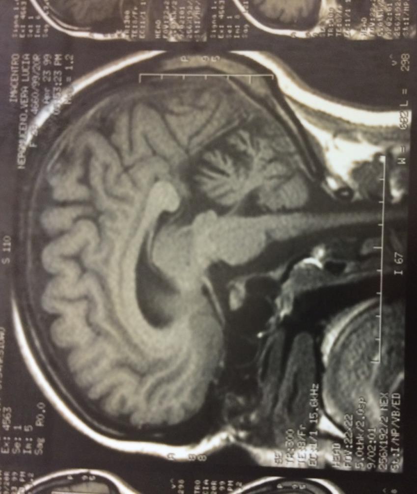 Exames complementares de diagnóstico Figura 6: RMN crânio-encefálica da doente 1. Realizada em 1999. Nesta RMN pode observar-se a atrofia do cerebelo.