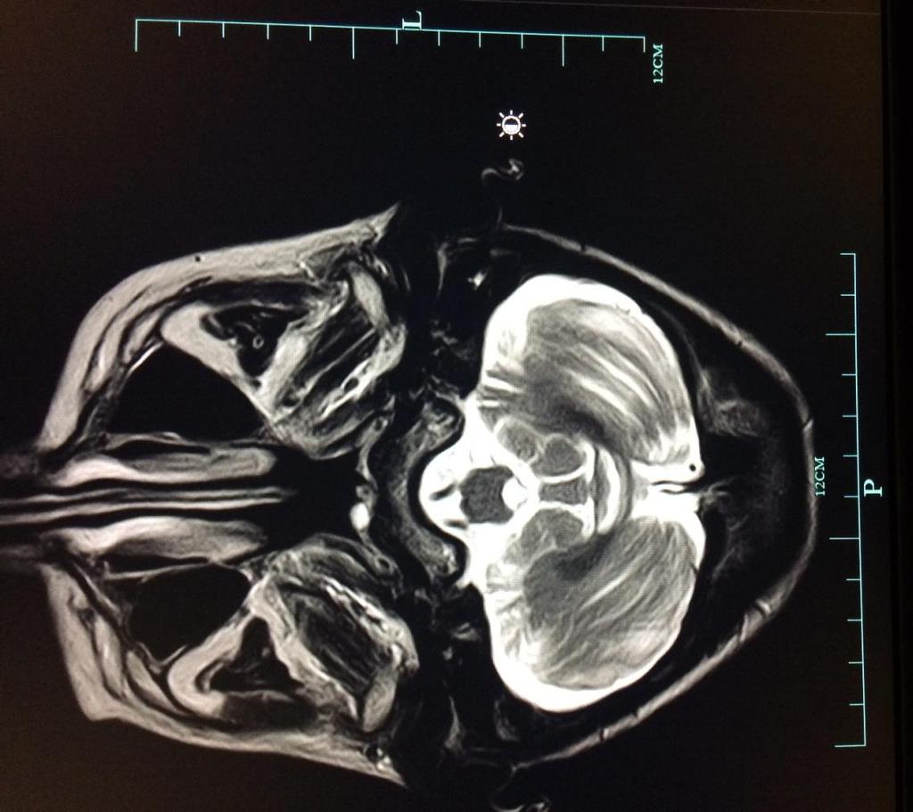 Figura 9: Corte axial da RMN crânio-encefálica da doente 2. Realizada em 2013.