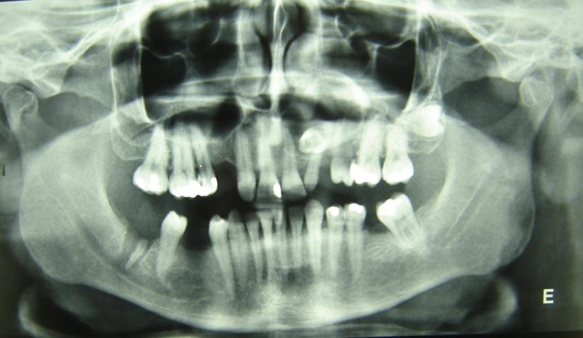 Ao exame intra bucal verificou-se tumefação sugestiva de expansão da cortical vestibular em região do elemento dentário 23, com mucosa apresentando coloração esbranquiçada, além da ausência do dente