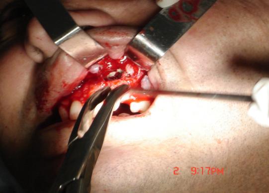 No mesmo tempo cirúrgico, realizou-se o tratamento cirúrgico que consistiu em uma incisão angular,