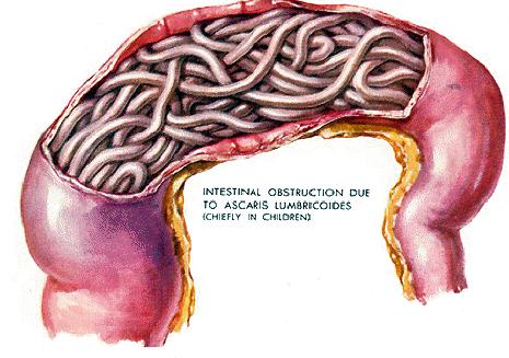 É a verminose intestinal humana mais disseminada no mundo.