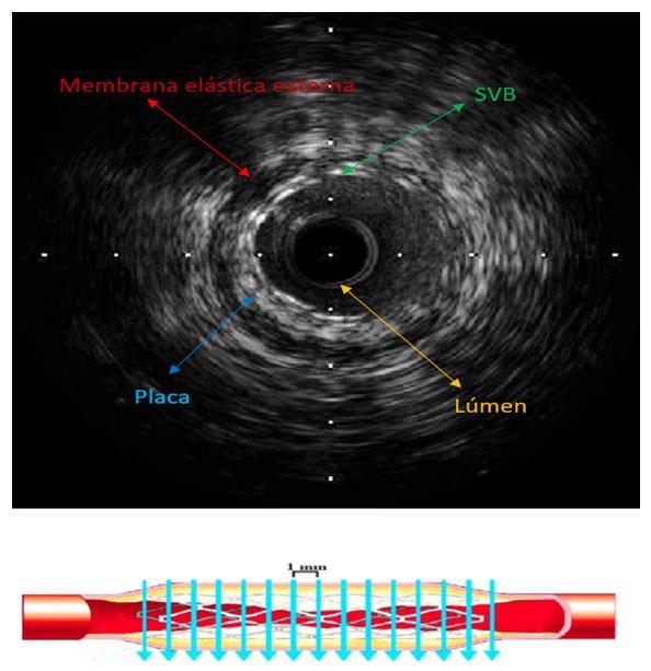 3 Métodos 29 Figura 3 Imagem do USIC demonstrando a localização da membrana elástica externa, placa, SVB e o lúmen da artéria para os cálculos das áreas.