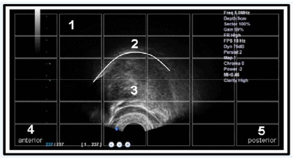 FONÉTICA CLÍNICA VINTE ANOS DE LIAAC Figura 10. Imagem de USG modo B usando transdutor endocavitário. 2. Traçado branco indica a posição do dorso da língua. 3. Estrutura do corpo da língua. 4 e 5.