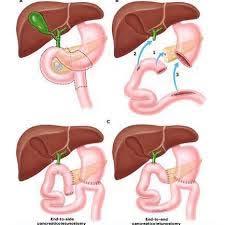 8 Observe a figura abaixo. Em relação à figura, é incorreto afirmar: A figura representa uma gastroduodenopancreatectomia cefálica, procedimento utilizado na ressecção de tumores periampulares.