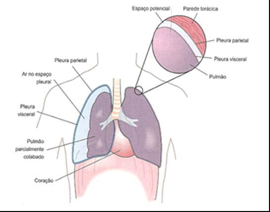 Pneumotórax Hipertensivo Entrada contínua de ar para o interior da cavidade torácica