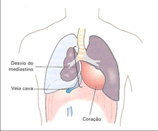 Se a quantidade de ar no espaço pleural continuar a aumentar, o pulmão do lado