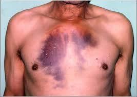 Contusão Pulmonar Presença de sangue e edema nos alvéolos dificultando a troca gasosa.