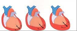 Tamponamento Cardíaco Acúmulo agudo de líquidos entre o saco pericárdico e o coração. Causa - ferimento por arma branca no coração.