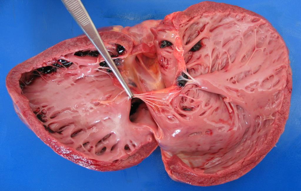 Defeito septal