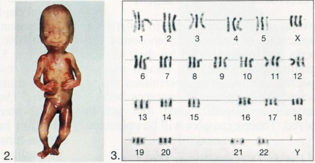 Euploidias Alteração no conjunto de cromossomos: