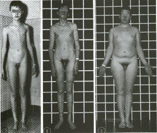 Síndrome de Klinefelter Trissomia do cromossomo X; Ocorre apenas em indivíduos do sexo masculino; O cariótipo apresenta 47 cromossomos; Sintomas: apresenta um
