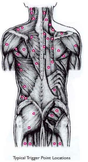 Trigger Point (Ponto Gatilho) Travell e Simons localizaram todos os Pontos Gatilhos (PG) e seus respectivos trajetos álgicos.