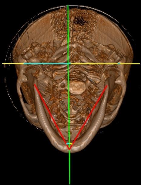 Avaliação Morfológica do Corpo Mandibular Angulo Corpo D 38.6 Angulo Corpo E 36.42 1.