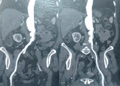 dilatação aneurismática fusiforme da aorta toracoabdominal, medindo 4,8 x 4,1 cm de diâmetros máximo, com início ao nível da emergência das artérias renais proximais, estendendo-se distalmente por