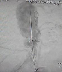 feita aortografia e microcateterismo de artéria hipogástrica esquerda e sua oclusão/embolização com duas molas interlok.