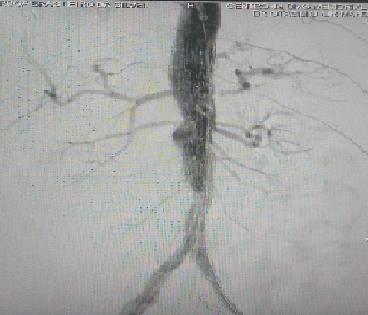 Figura 4 angiografia após liberação do corpo principal da endoprotese, mostrando bom posicionamento do dispositivo, ausência de vazamentos e manutenção da perfusão visceral.