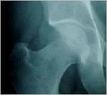 Pequenos fragmentos de osso e/ou cartilagem que se soltam, devido a traumatismos como fraturas, ou mesmo em doenças degenerativas como artrose.