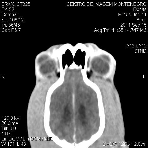 Coronal TC