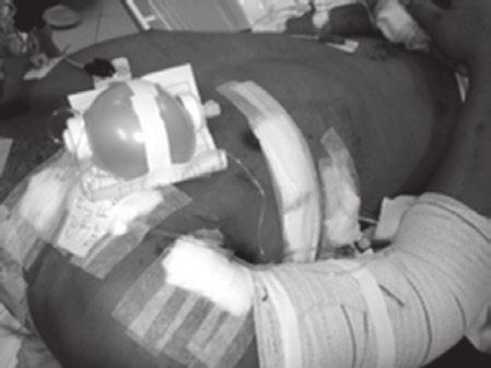 A alta do CTI ocorreu após 36h e a alta hospitalar foi dada no nono dia de pós-operatório. DISCUSSÃO Figura 3 - Seta mostrando o cateter na ferida operatória.