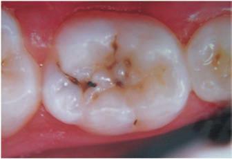 lesão de cárie na superfície oclusal, envolvendo dentina e com uma abertura menor ou igual a 3 mm no esmalte da superfície oclusal (Figuras 1 e 2).