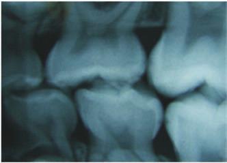 FIGURA 3 Aspecto radiográfico inicial da lesão de cárie no dente 75. FIGURA 4 Aspecto radiográfico inicial da lesão de cárie no dente 75.
