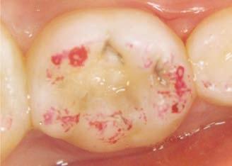 FIGURA 6 Aspecto clínico após restauração com resina composta do dente 75. Ao final do procedimento, na mesma sessão, foi realizada uma radiografia interproximal padronizada.