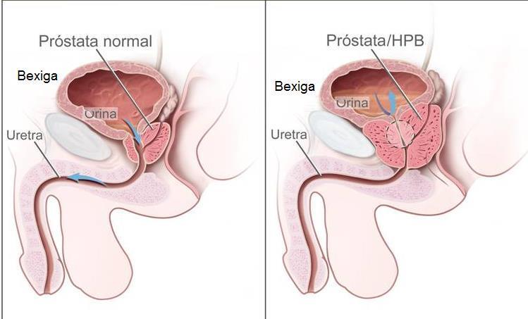 Tecido Muscular Hiperplasia x Hipertrofia Embora frequentemente em muitos órgãos, a hiperplasia não acontece no músculo