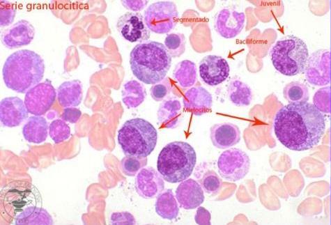 Figura 3. Esfregaço de sangue periférico (LMC). Neutrófilos em várias fases de maturação. Fonte: minutoenfermagem.com.