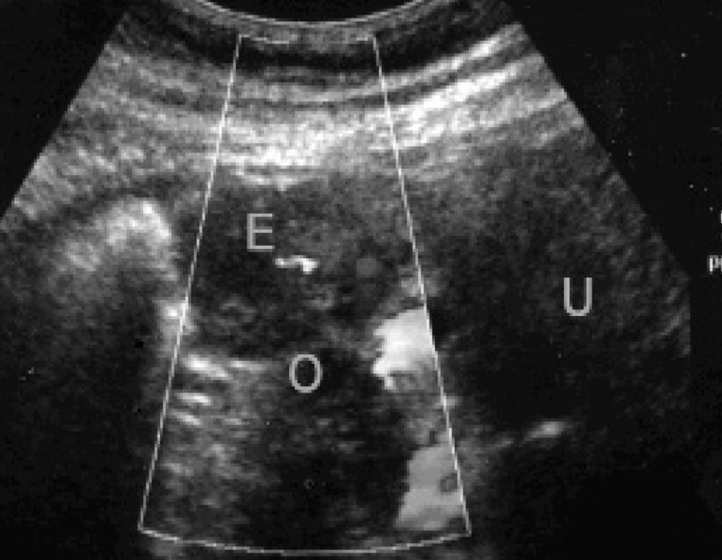 Gravidez abdominal: Se desenvolve na cavidade peritoneal Unusual