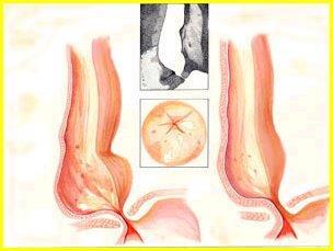 Cardiomegalia