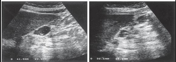 intra-abdominal T1/2 do