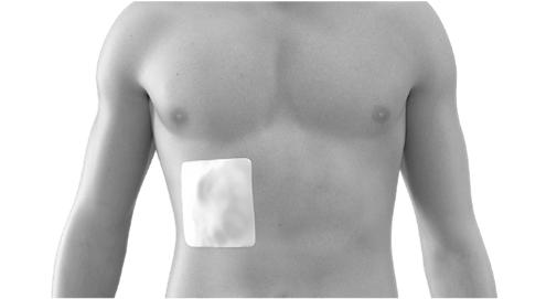 pleural, tunelizado subcutaneamente e