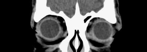 ÓRBITA Ligamento palpebral medial