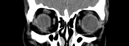 ÓRBITA Face orbital (osso maxilar)