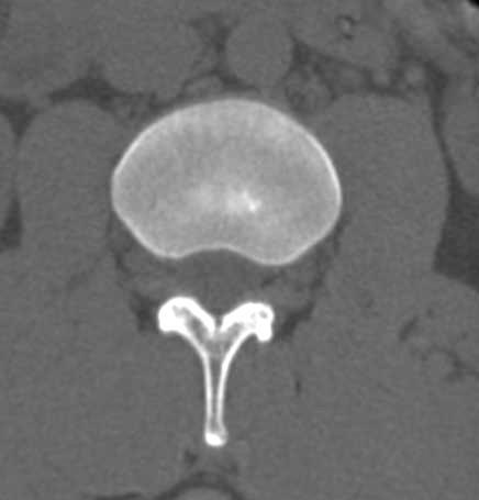 FORAME INTERVERTEBRAL Coluna