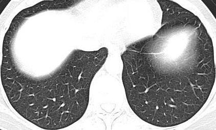 TÓRAX (janela pulmonar) L Língula Fissura acessória